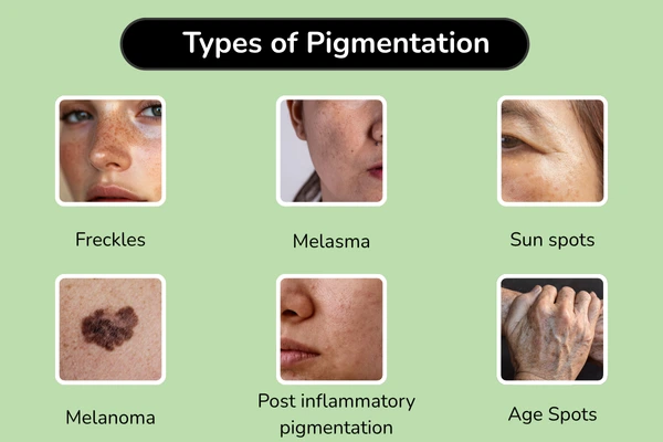 Types of pigmentation