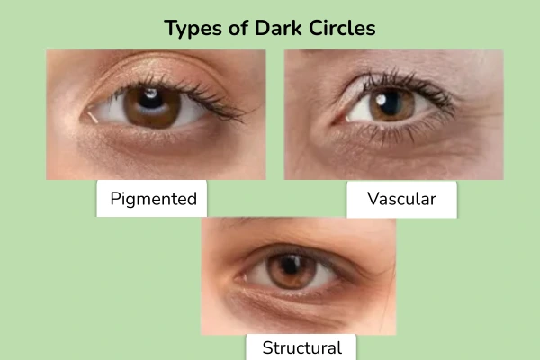Types of dark circles or dark spots under eye