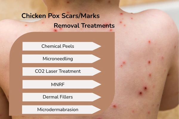 chicken pox marks removal treatments