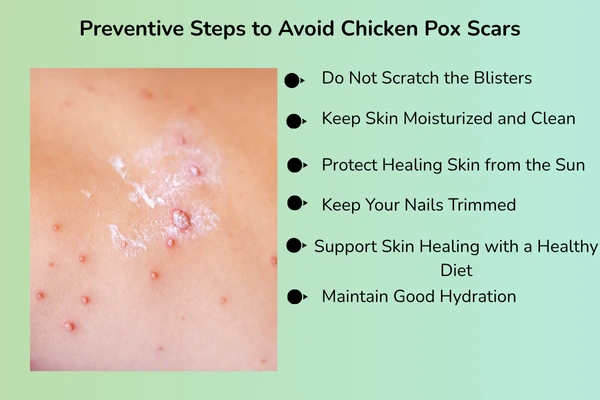 Preventive tips for chicken pox scars