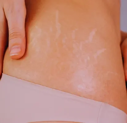 A women experiencing stretch marks on buttocks