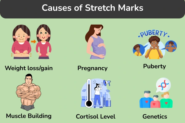 Causes of stretch marks
