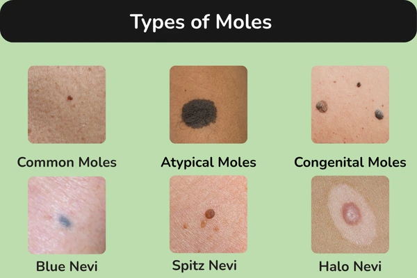 Types of moles on face