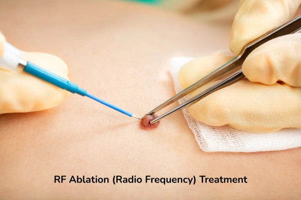 A dermatologist removing mole using RF ablation - radio frequency ablation treatment procedure.