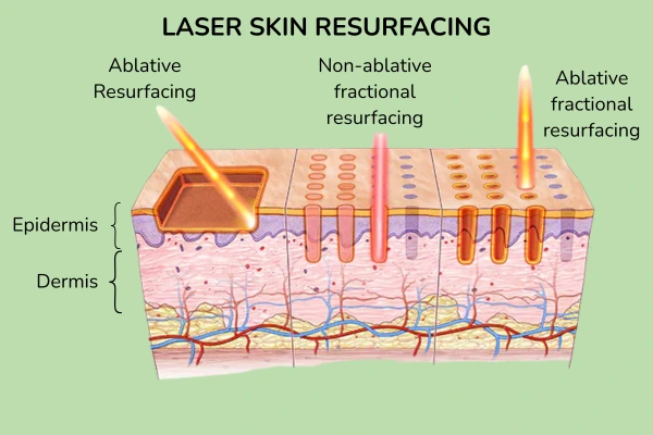 Laser Skin Resurfacing