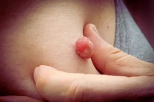 Women showing her Skin Tag on her skin