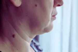 A women with moles on face and neck area