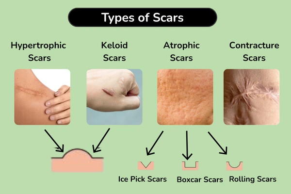types of scars