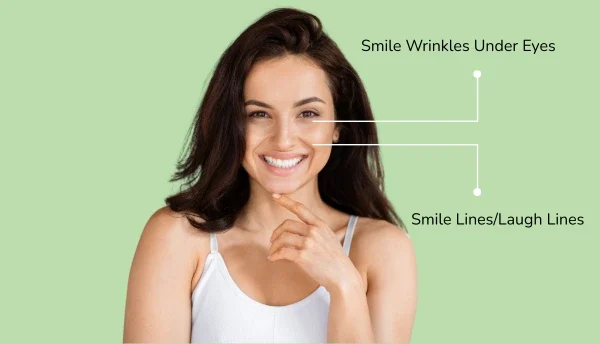 Smile lines