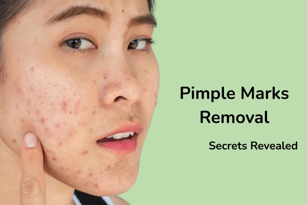 A women with pimple marks on face