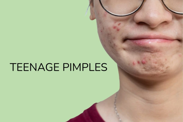 A young women with Teenage Pimples