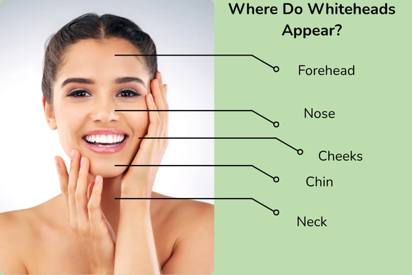 Where do whiteheads appear?