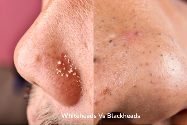 Image describing the difference between whiteheads and blackheads
