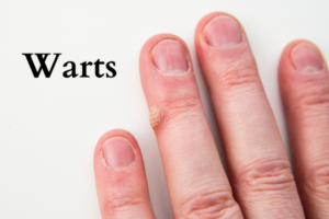 Warts on fingure
