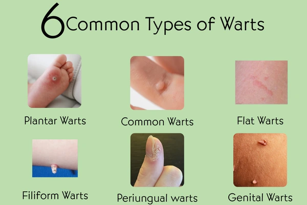 Types of skin warts