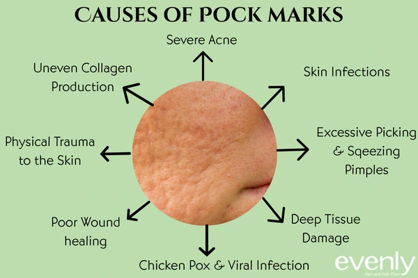What causes pockmarks on face?