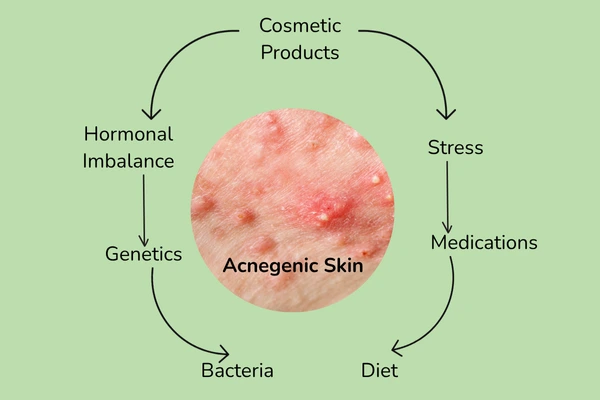 Causes of acnegenic skin