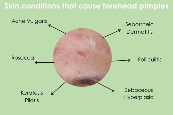 Skin conditions that cause forehead pimples