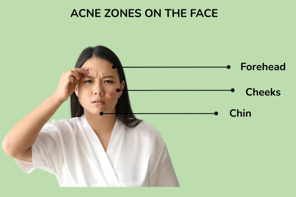 Acne zones on the face