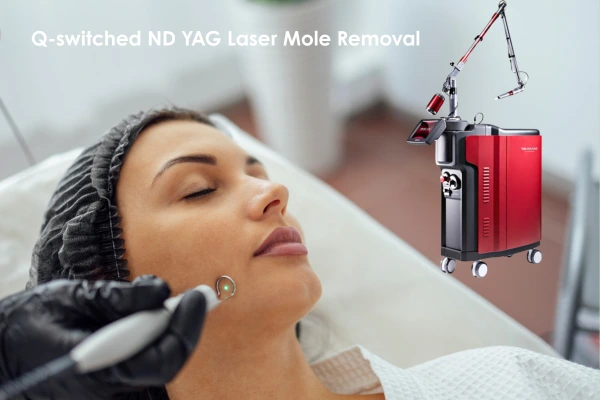 moles on face treatment  with Q siwtched ND YAG Laser