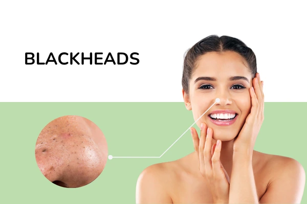 Blackheads 