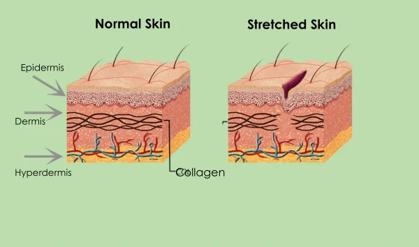 A scientific image differentiating good healthy and stretched skin