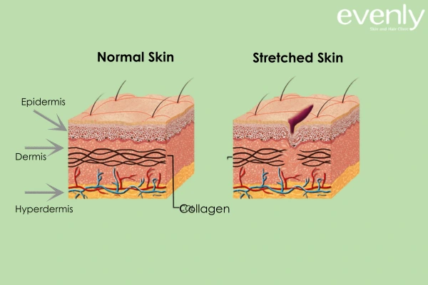 Stretch Marks