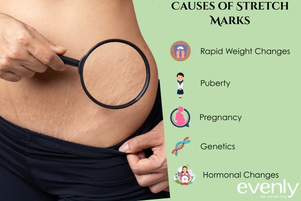 Causes of Stretch Marks