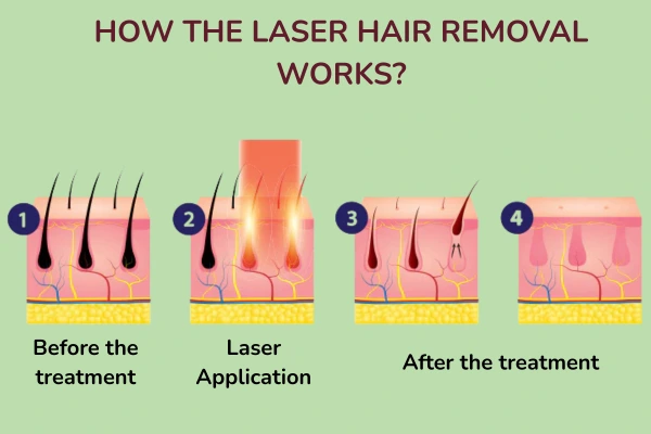 How does laser hair removal treatment works?