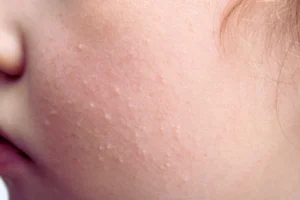 A young girl with milia on her cheeks