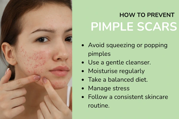 How to prevent pimple scars