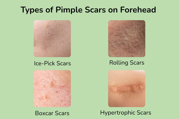 Types of pimple scars on forehead