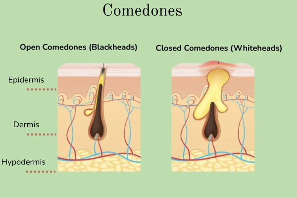 What are comedones?