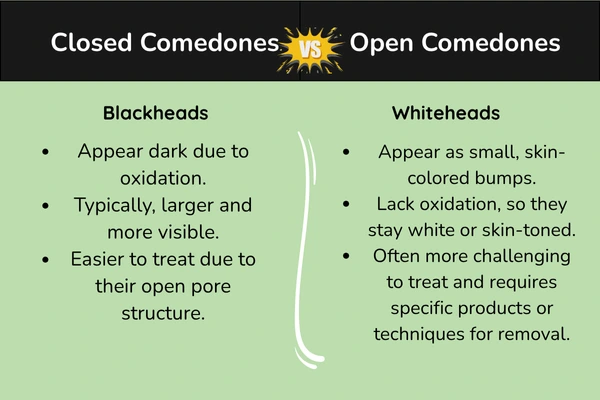 Closed comedones Vs Open comedones
