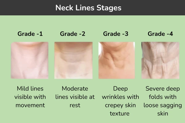 Stages of neck lines or wrinkles