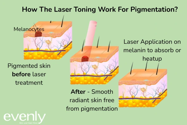 How Laser Toning treatment Works for Pigmentation