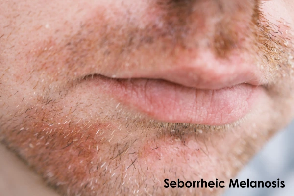 seborrheic melanosis