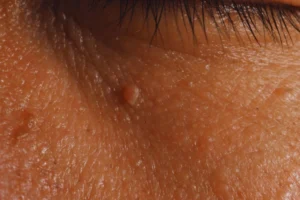 A women with warts on face close up view