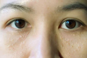 A women with milia on face, speciallytyy under eye area