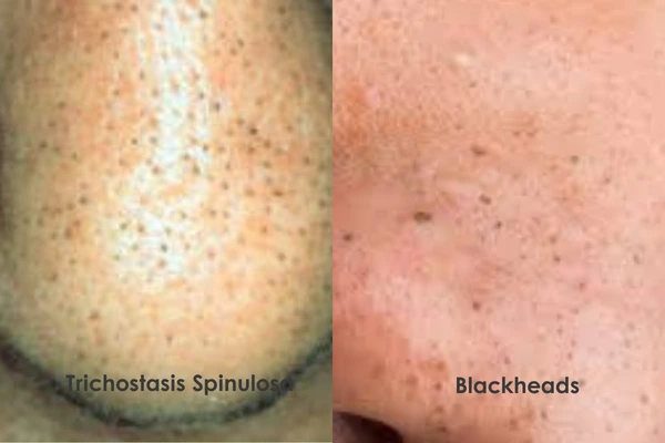 An image differentiating trichostasis spinulosa and blackheads