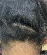 The same patient with hair growth on the patch after takig multiple sessions of growth factor concentrate treatment.