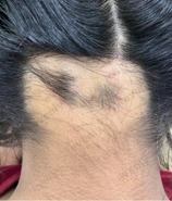 The patient with a visible patch - with hair loss on the scalp before undergoing growth factor concentrate treatment.