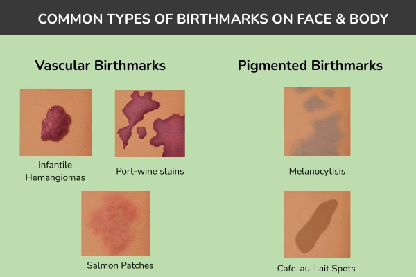 Types of birthmarks on face and body