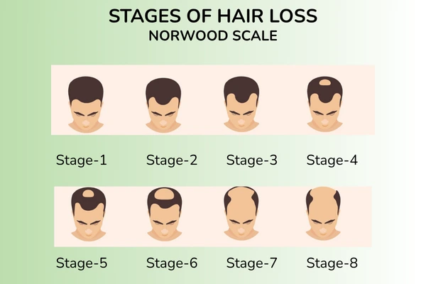 Male pattern baldness stages