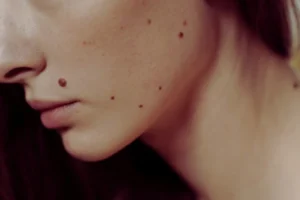 A women with moles on her face