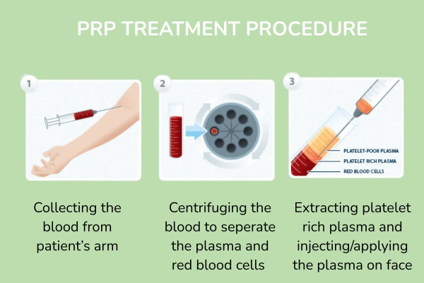 PRP Treatment For Face Treatment Procedure
