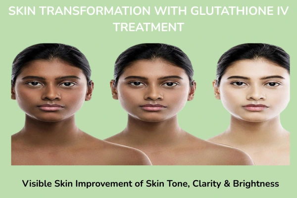 Skin transformation with Glutathione IV treatment