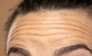 Forehead Fine lines