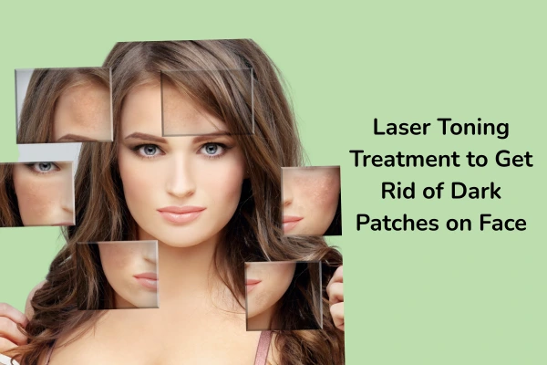 Laser toning treatment to get rid of dark patches on face