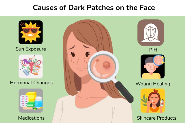 Causes of dark patches on face